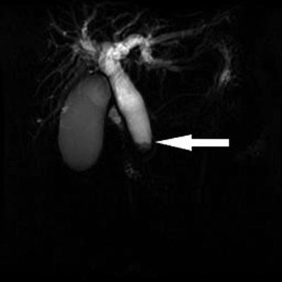 Metachronous pancreatic cancer 18 years after resection of common bile duct cancer: A case report